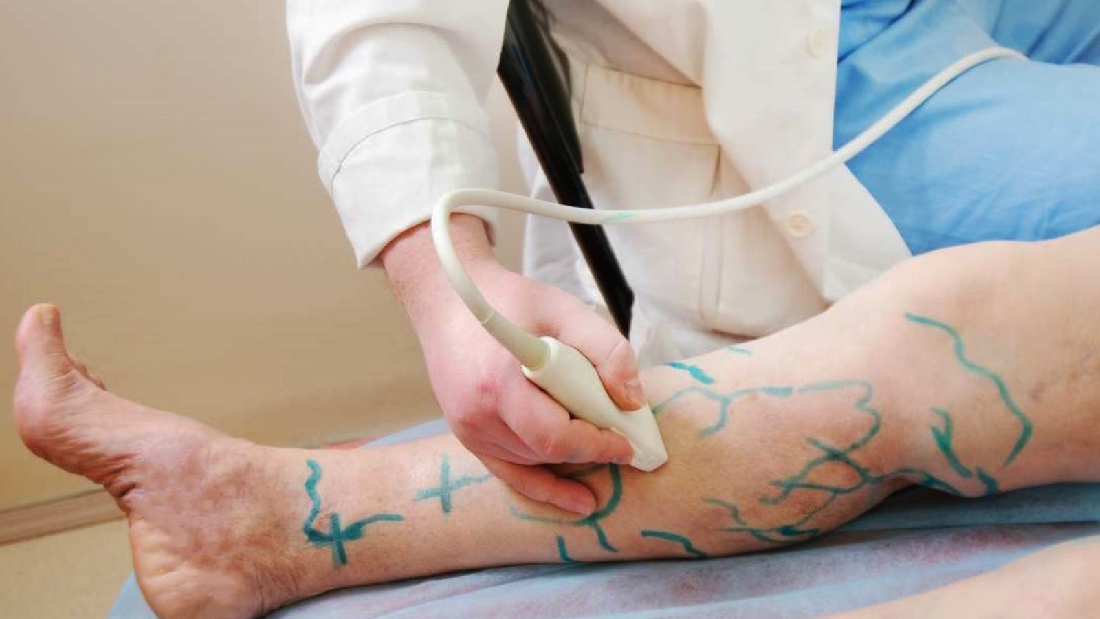 tratamento-varizes-dr-daniel-benitti-cirurgiao-vascular-sao-paulo-campinas-1600x900-1