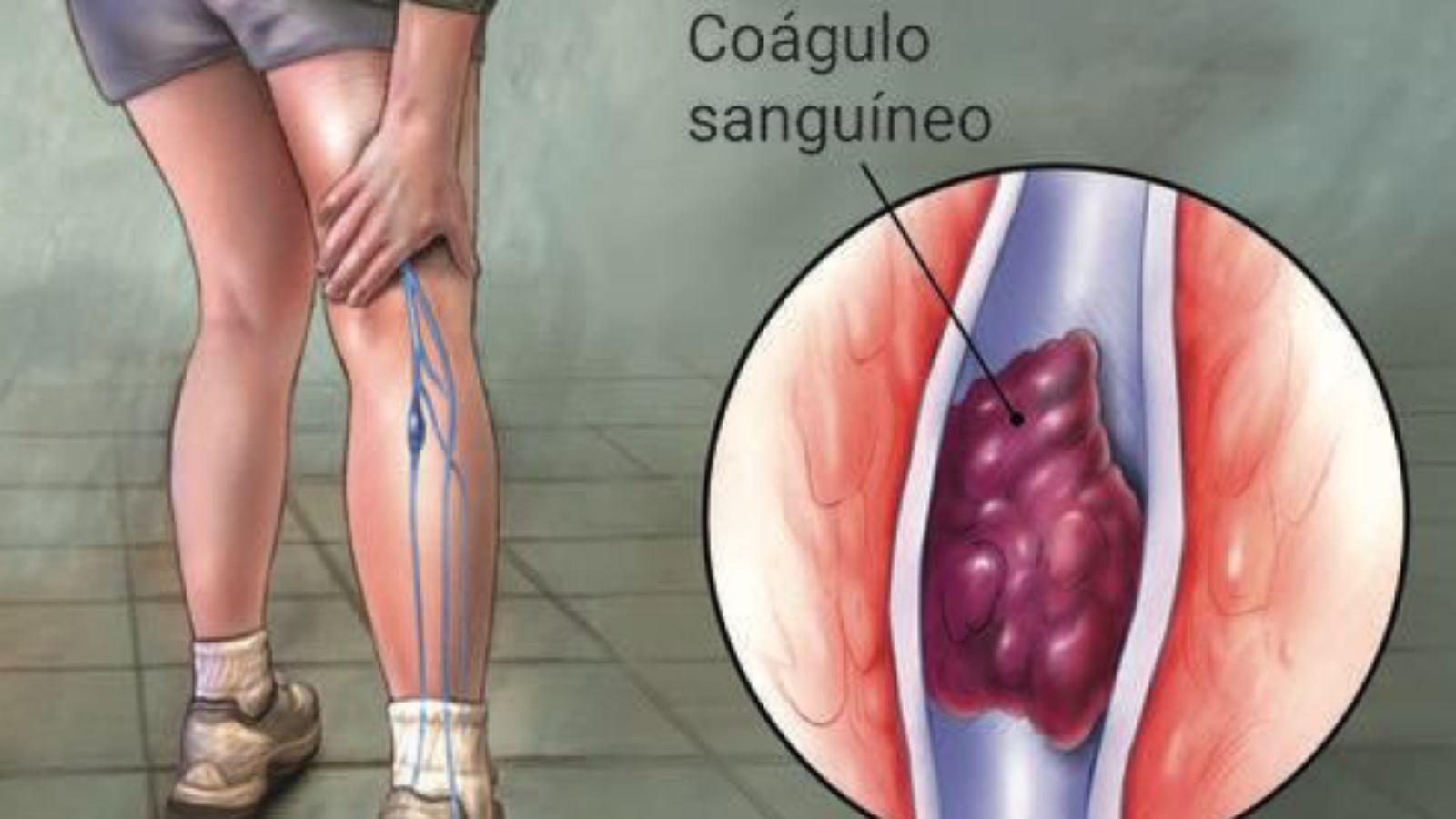 trombose-venosa-profunda-dr-daniel-benitti-cirurgiao-vascular-sao-paulo-campinas-1-1600x900