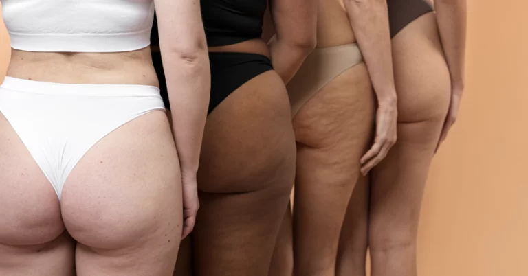 O Lipedema, também conhecido como lipodistrofia dolorosa, é uma condição médica crônica que afeta principalmente mulheres, caracterizada por um acúmulo anormal de gordura nas pernas e, em alguns casos, nos braços. Essa condição vai além da simples obesidade, causando dor, inchaço e alterações na textura da pele, impactando significativamente a qualidade de vida das pacientes.